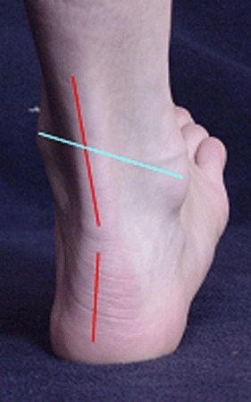 a középső láb ízületének 2 stádiuma artrózisa)